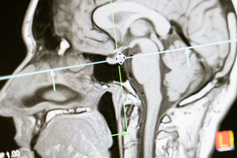 Common Brain and Nerve Disorders Explained